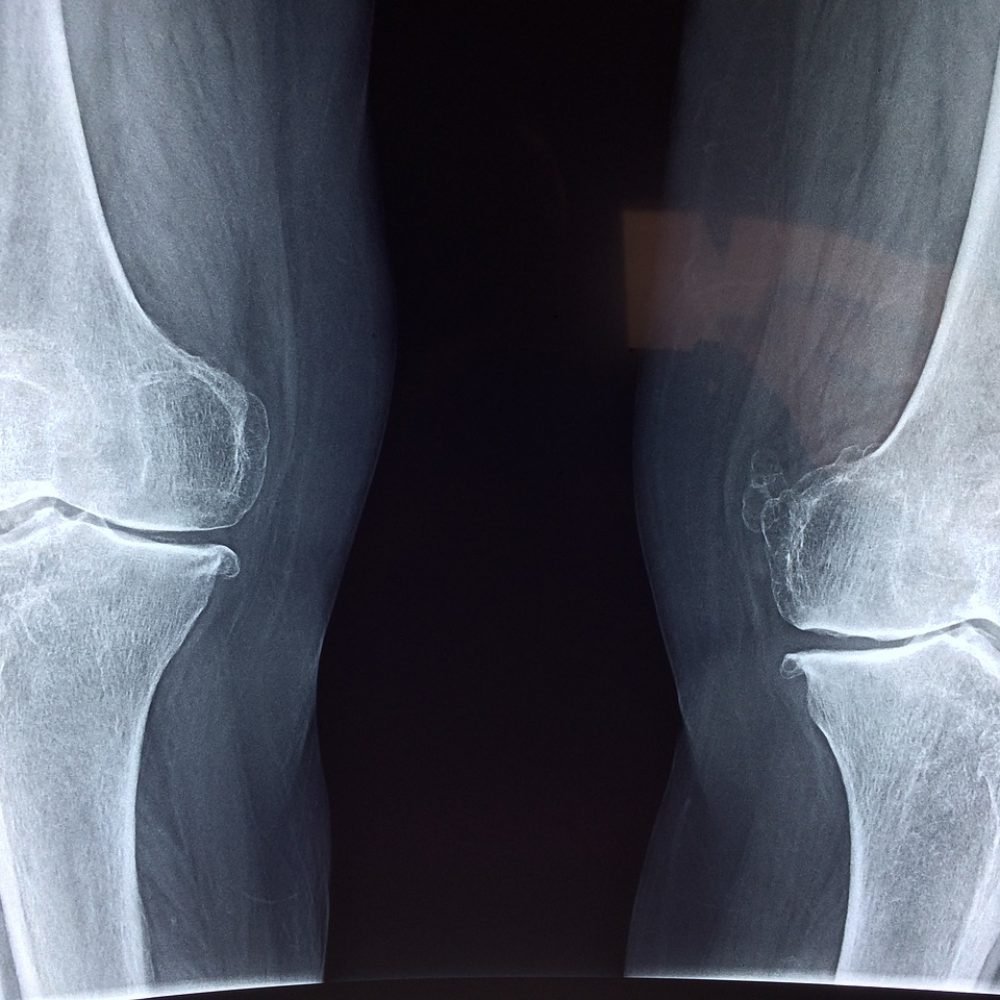 knee, x-ray, medical